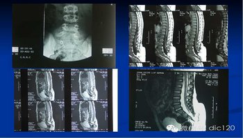如隐性脊柱裂,脊膜膨出,脊髓脊膜膨出,脊髓终丝紧张,腰骶椎管内脂肪瘤