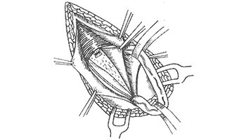 下壁为腹股沟韧 带,内口为腹股沟管深环,位于腹股沟韧带中点上方一横