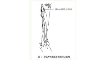 外伤 最为常见,多见于腓骨头,颈处骨折,胫骨外侧平台骨折,足内翻损伤