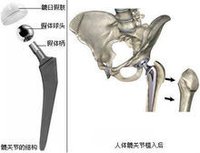 医用钛合金