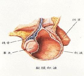 睾丸鞘膜积液